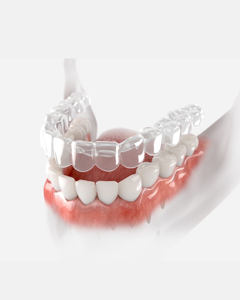 Invisalign®