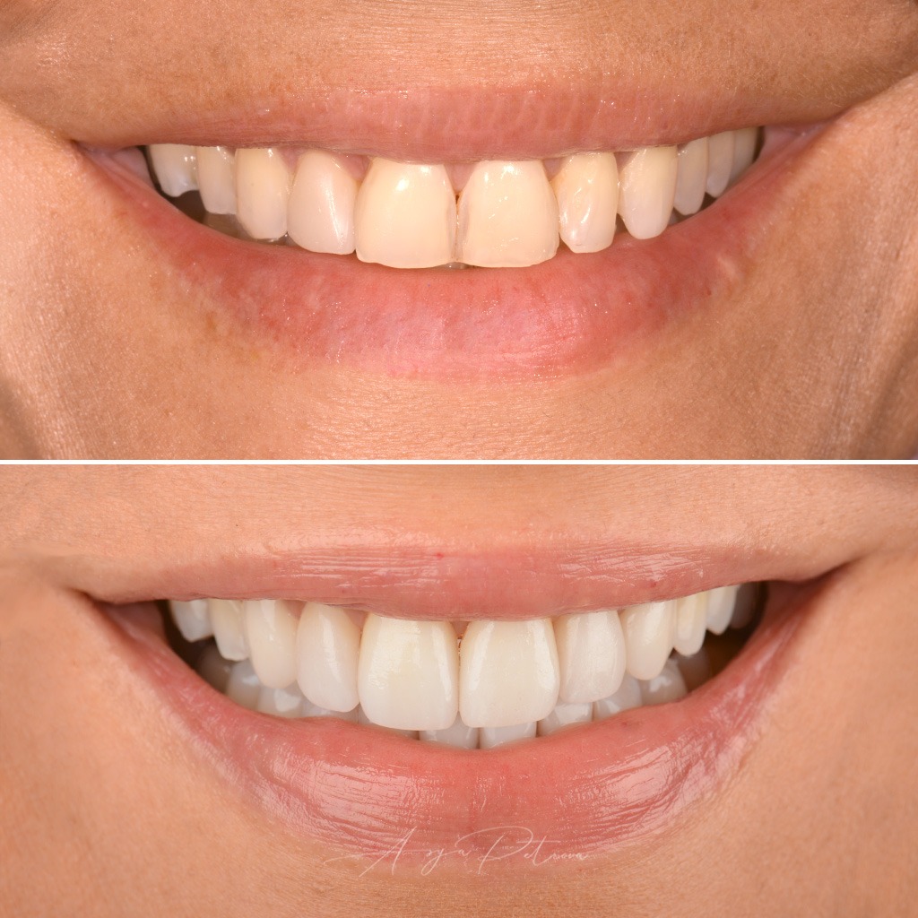 Porcelain Veneers - Case 2