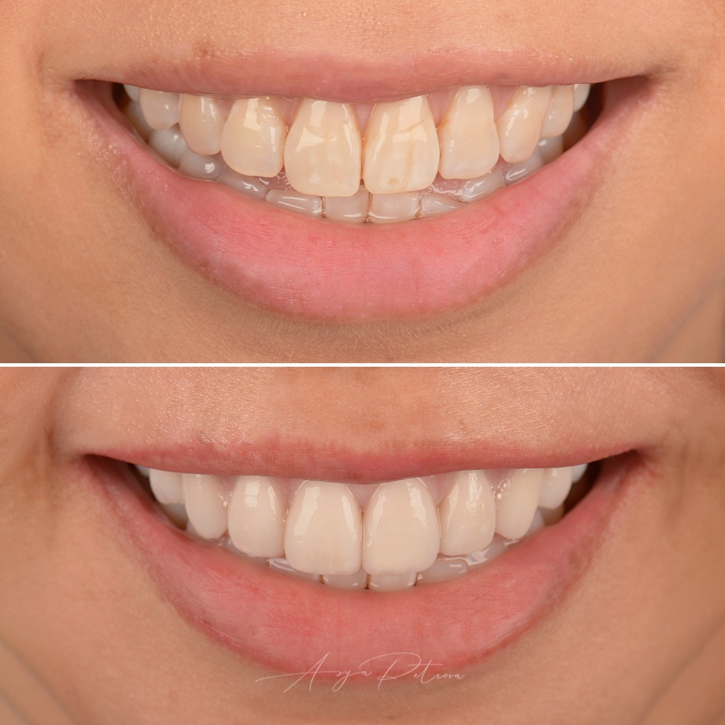 Porcelain Veneers - Case 5