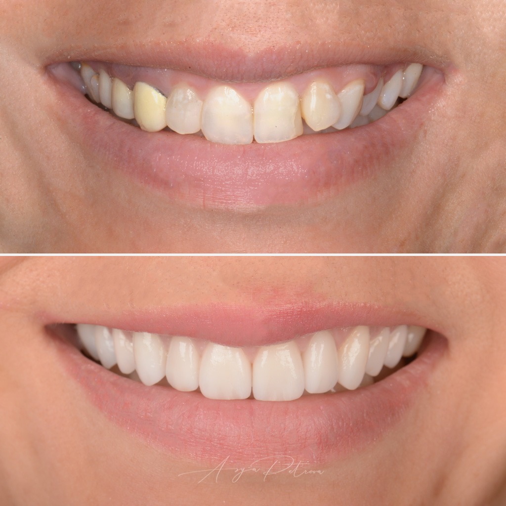 Porcelain Veneers - Case 8