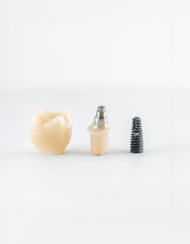 dental implants