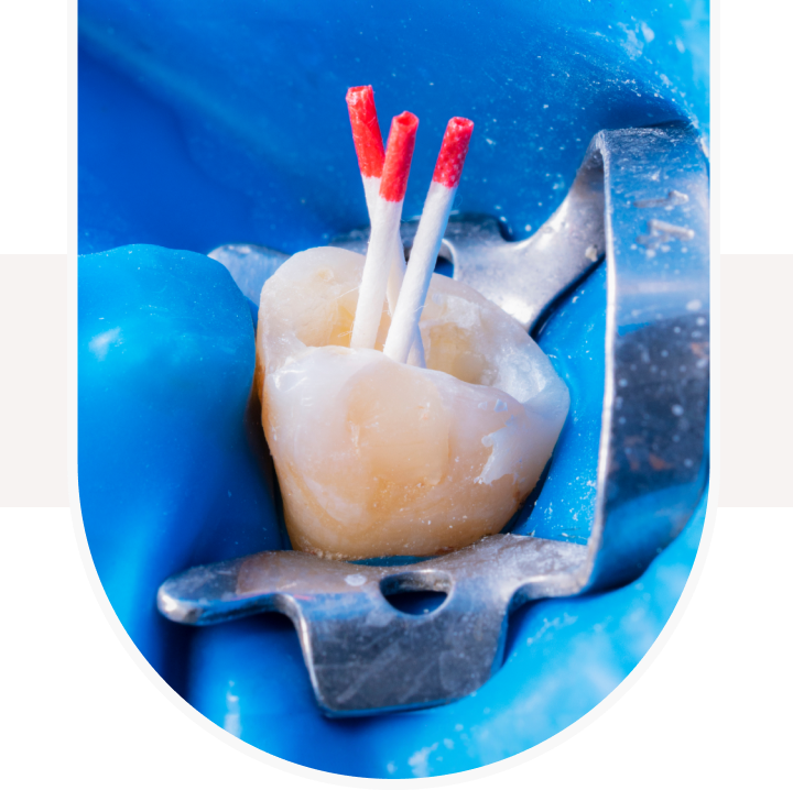 root canal treatment