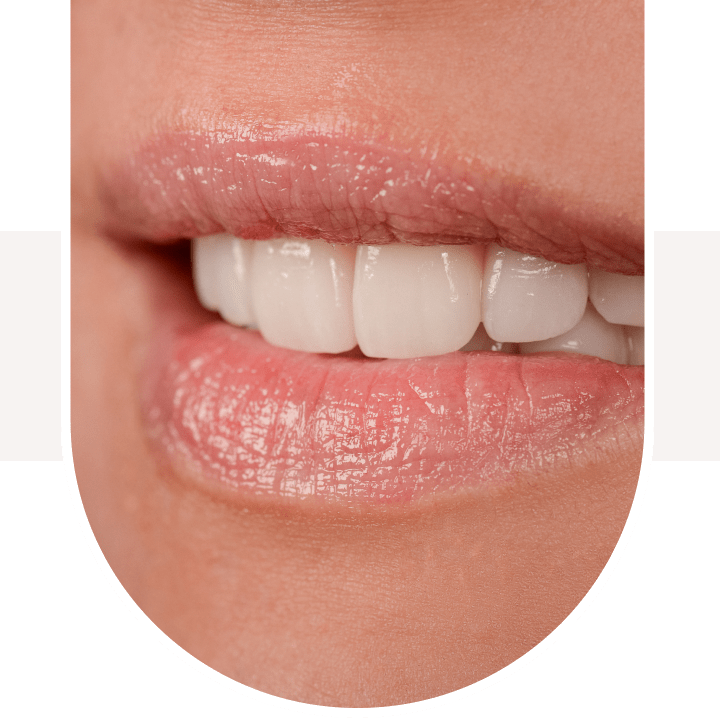 porcelain veneers