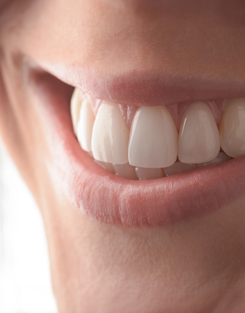 porcelain veneers